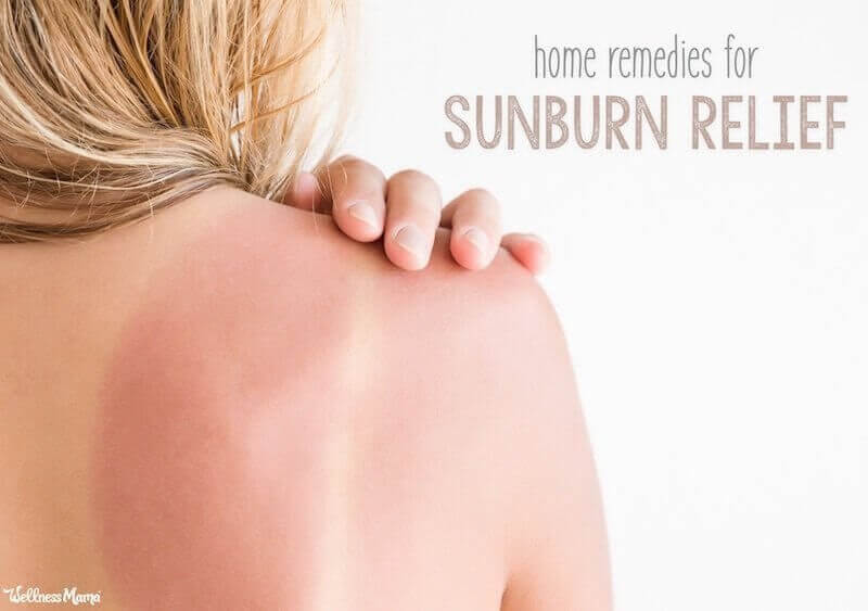 what to do for a sunburn home remedies