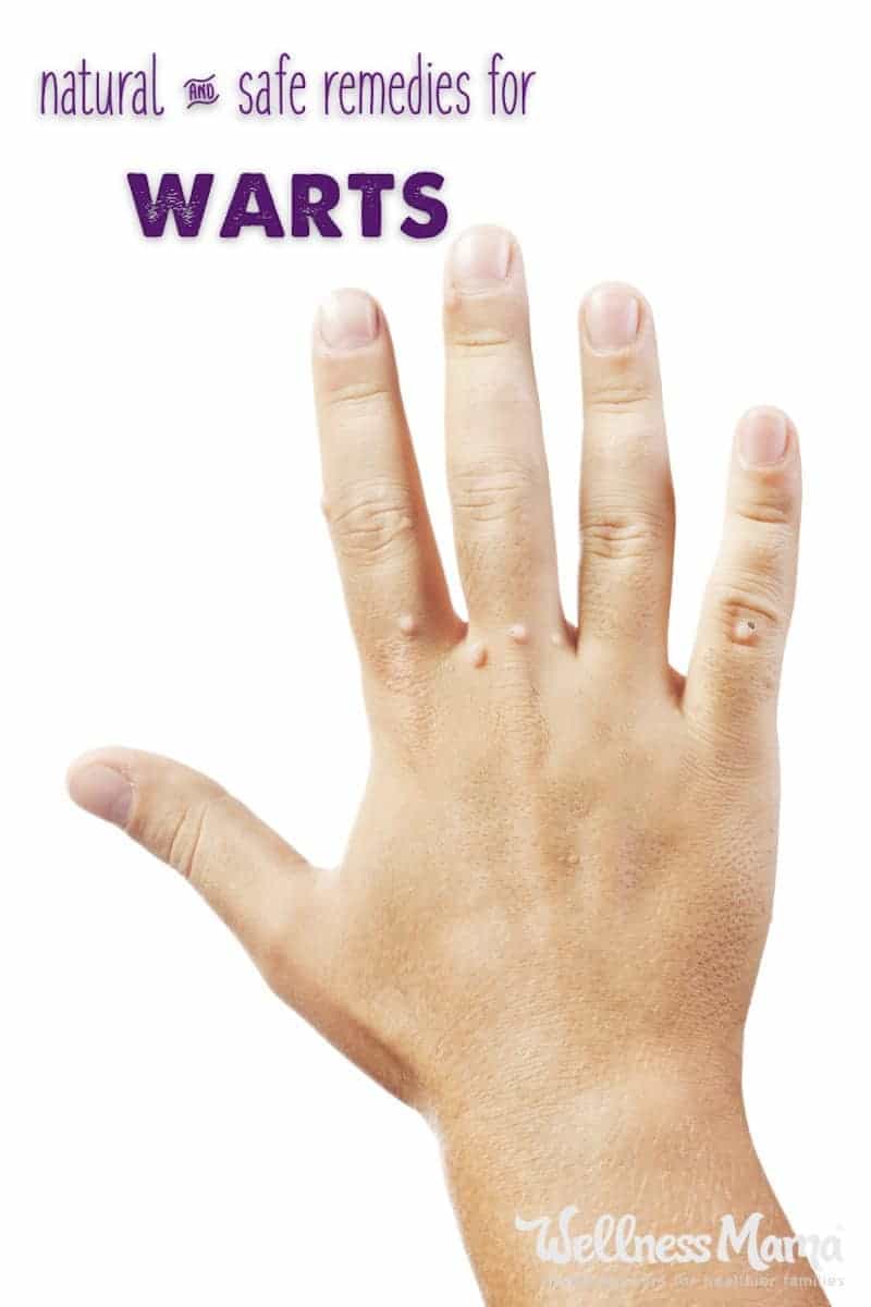 natural remedies warts